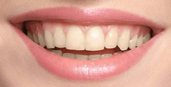 Zuby pred bielením s pásikmi Crest 3D White Professional Effects