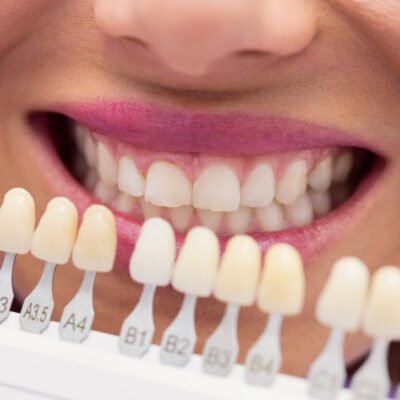 Porovnávanie odtieňa zubov